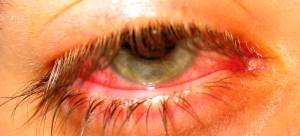 A bloodshot eye from infection