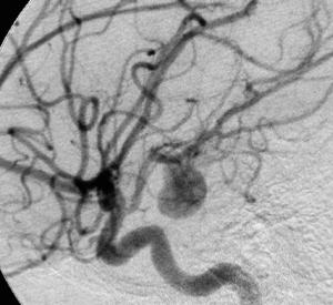 An angiograph of a brain aneurysm