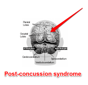 Post concussion syndrome