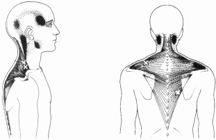 Trigger point diagram from Taking Control of TMJ
