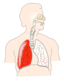 Migraine and Asthma