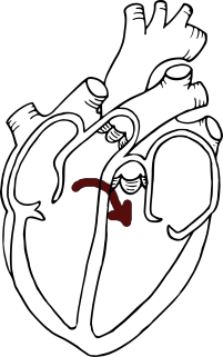 patent foramen ovale