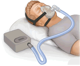 CPAP and Headaches
