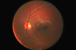 Image from a retinal scan