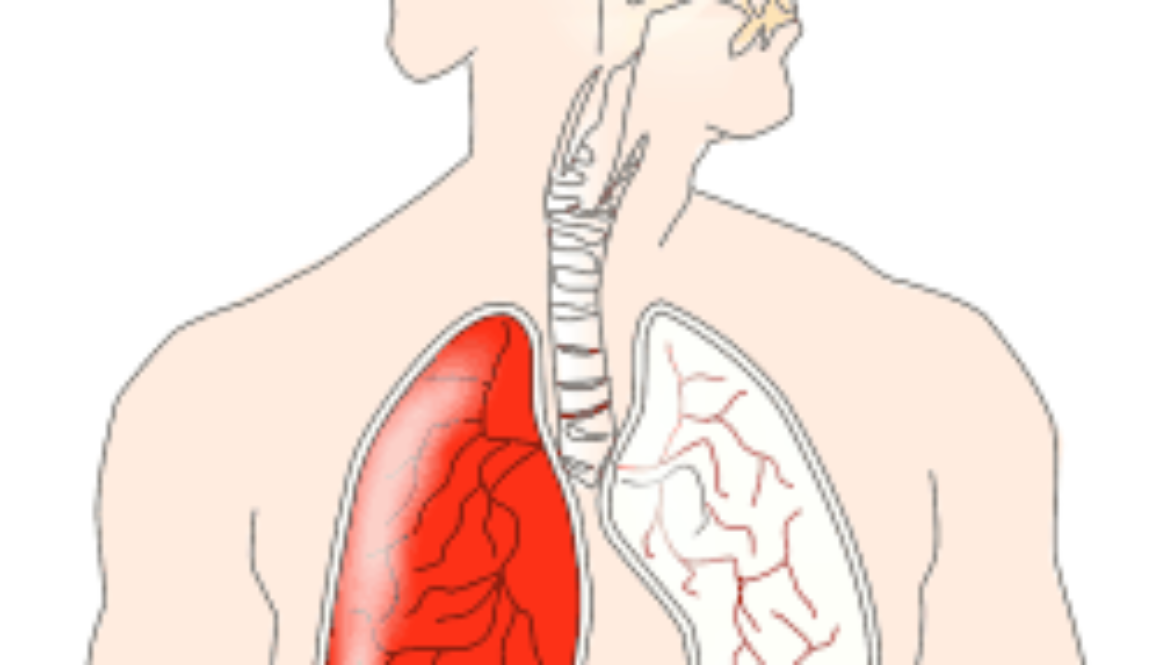 Migraine and Asthma