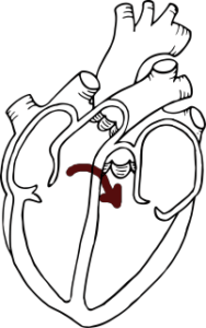 PFO Closure for Migraine: An Update - Headache and Migraine News