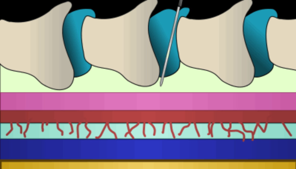 Epidural