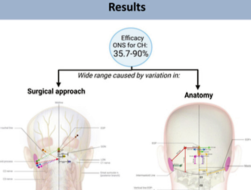 Occipital Nerve Stimulation results are varied!